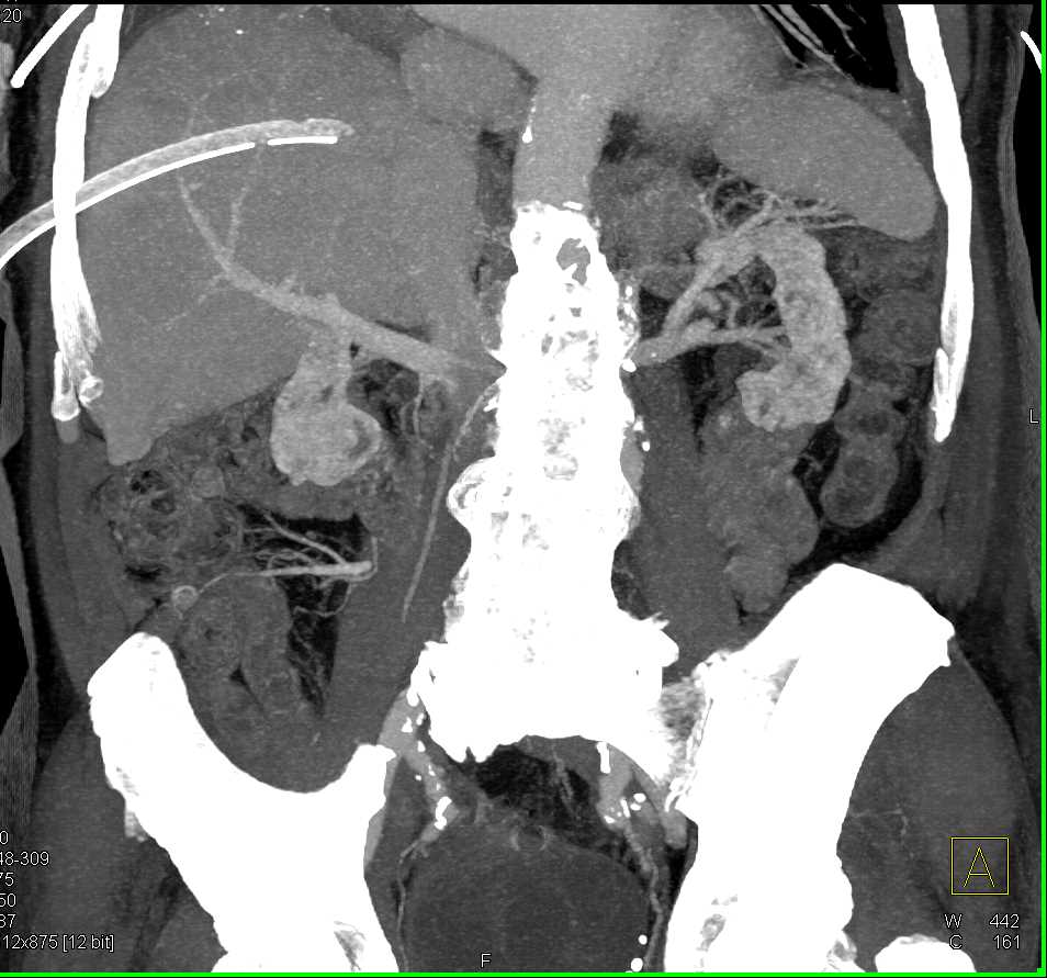 Chest Tube Placed in Liver - CTisus CT Scan