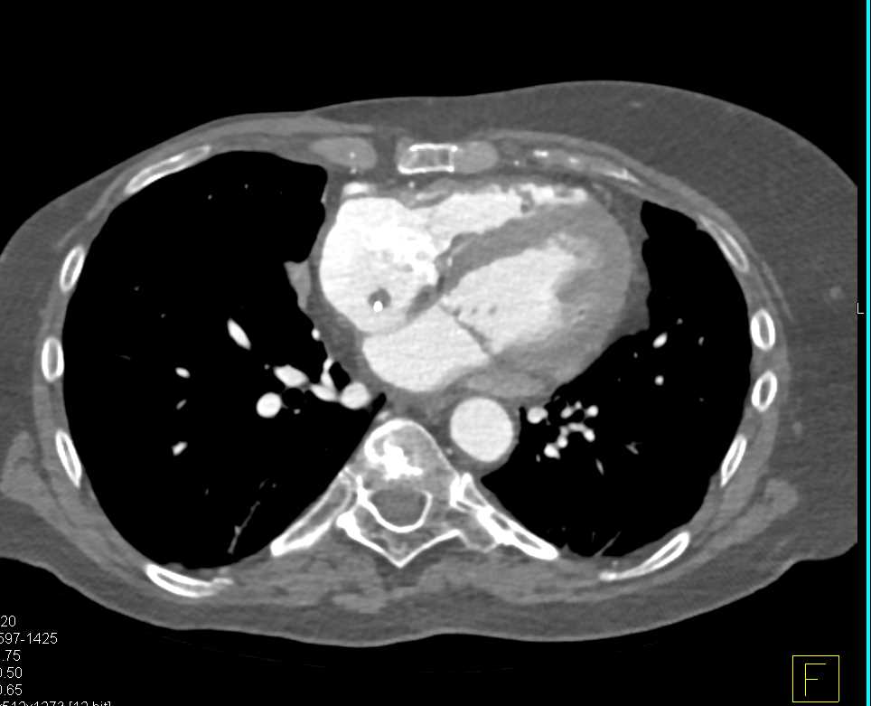 Right Mastectomy and Clot in Right Atrium - CTisus CT Scan