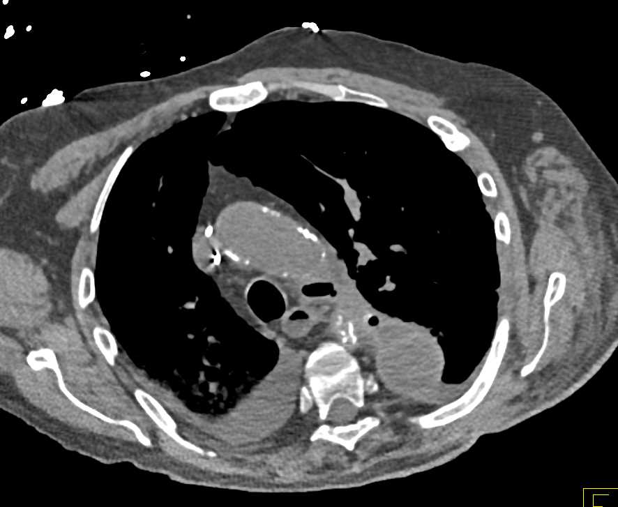 Mediastinal Abscess - CTisus CT Scan