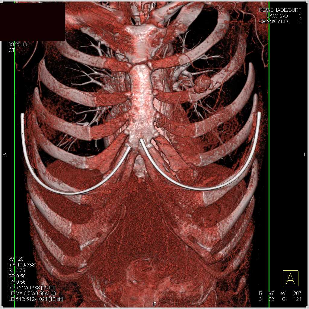 2cm Cancer Left Breast - CTisus CT Scan