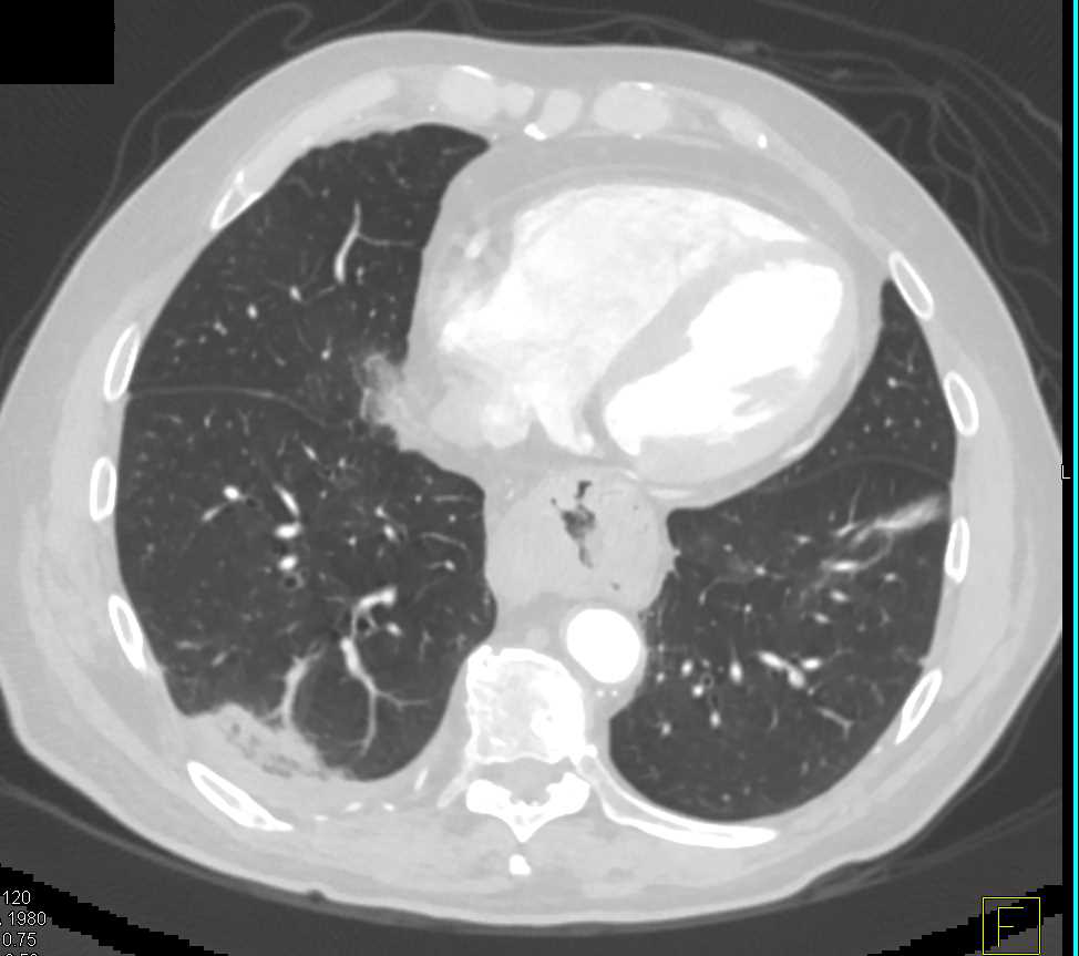 Multiple Pulmonary Emboli (PEs) in a Patient with Pancreatic Adenocarcinoma - CTisus CT Scan