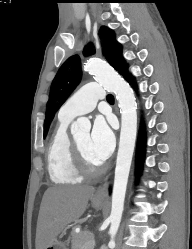 Stent in Distal Aortic Arch - CTisus CT Scan