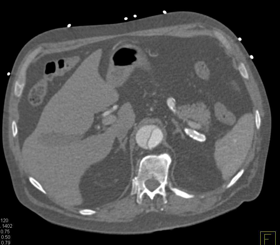 Type A Dissection with Bleed Left Upper Lung - CTisus CT Scan