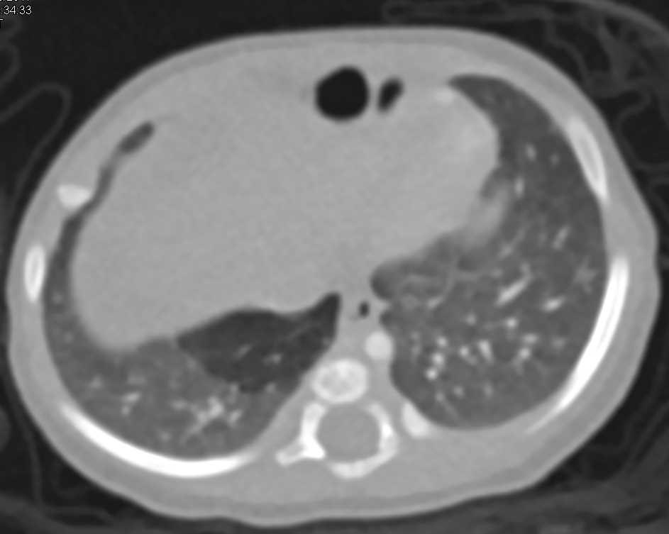 Air Trapping in the Right Lower Lung - CTisus CT Scan