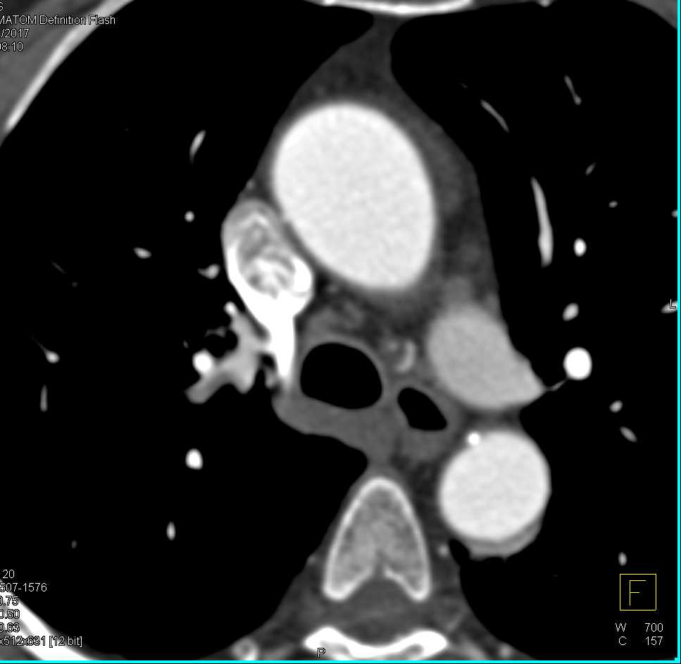 Pulmonary Embolism Right Lung - CTisus CT Scan