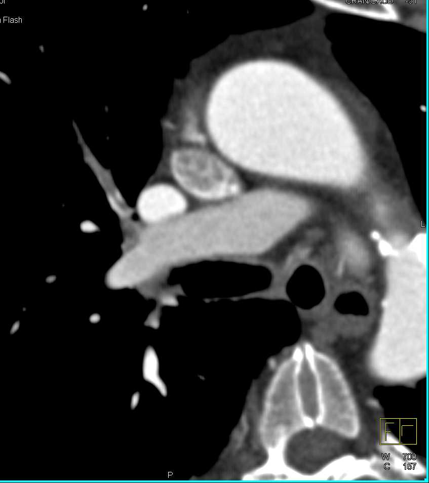 Pulmonary Embolism Right Lung - CTisus CT Scan