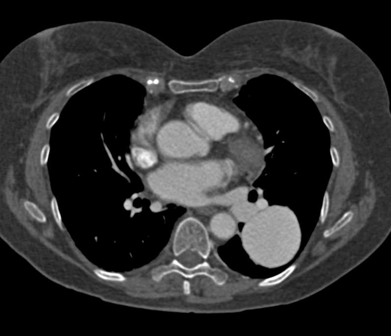 Pulmonary Artery Aneurysm - CTisus CT Scan
