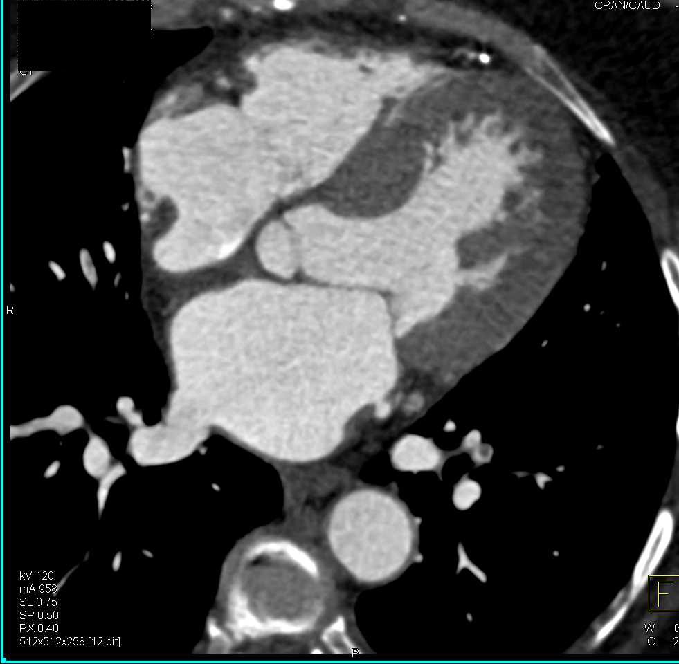 Pulmonary Embolism Left Lower Lobe Pulmonary Artery - CTisus CT Scan