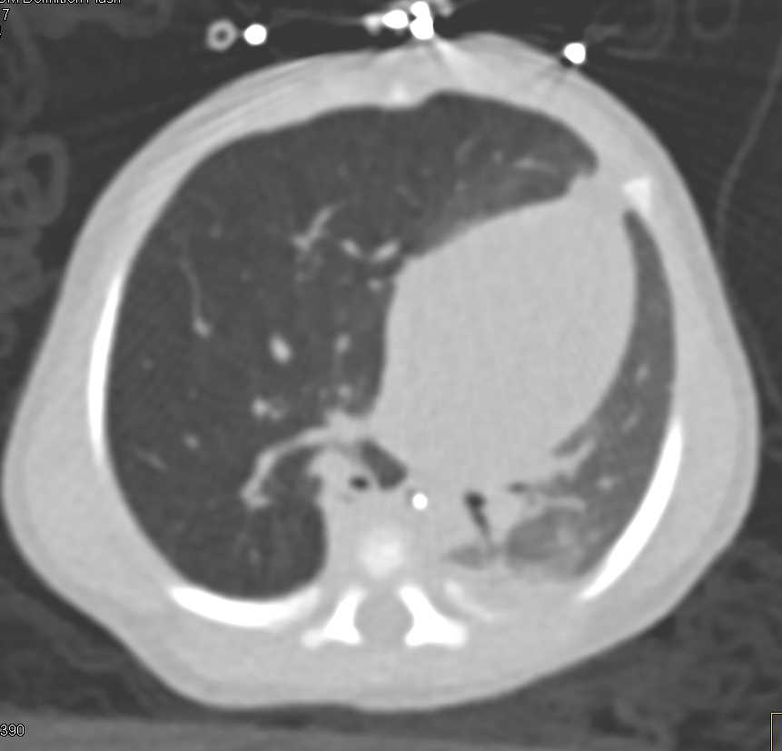 Emphysematous Changes Right Lung - CTisus CT Scan