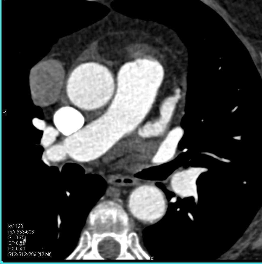 Thymoma - CTisus CT Scan