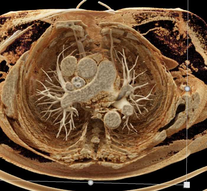 Thymoma with Cinematic Rendering - CTisus CT Scan