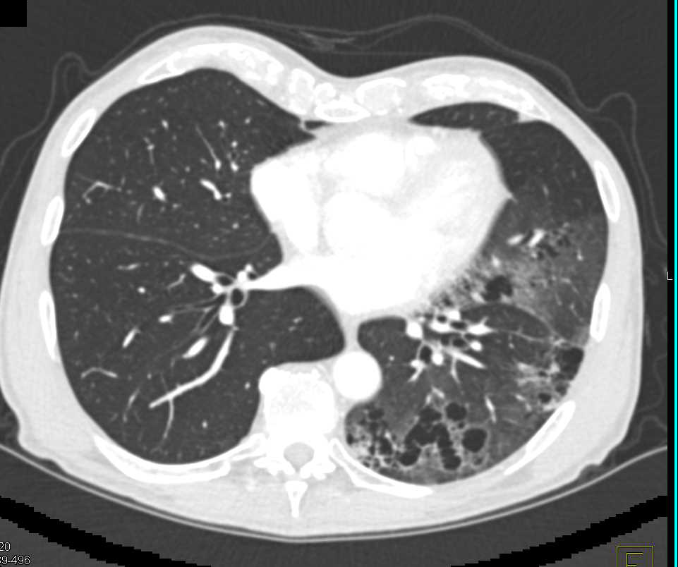 Inflammatory Changes Left Lower Lung with Cystic Air Spaces - CTisus CT Scan