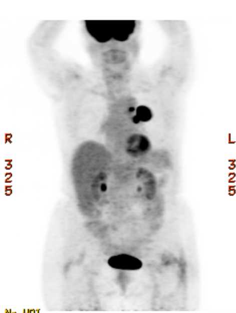Lung Cancer with Left Hilar Adenopathy - CTisus CT Scan