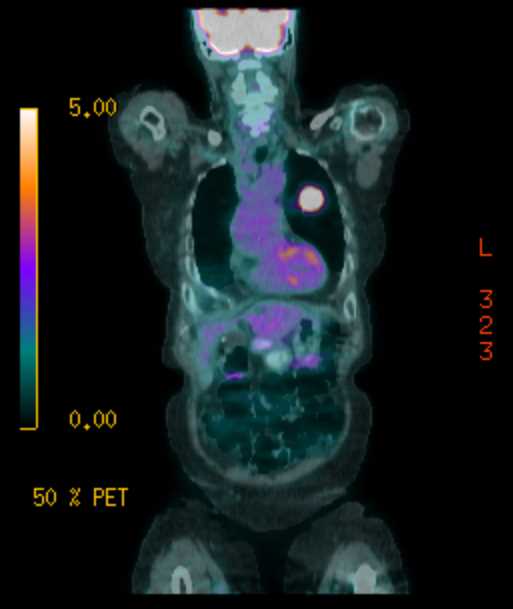 Lung Cancer with Left Hilar Adenopathy - CTisus CT Scan