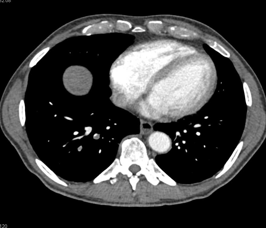 Pulmonary Embolism in a Patient with Newly Diagnosed Pancreatic Adenocarcinoma - CTisus CT Scan