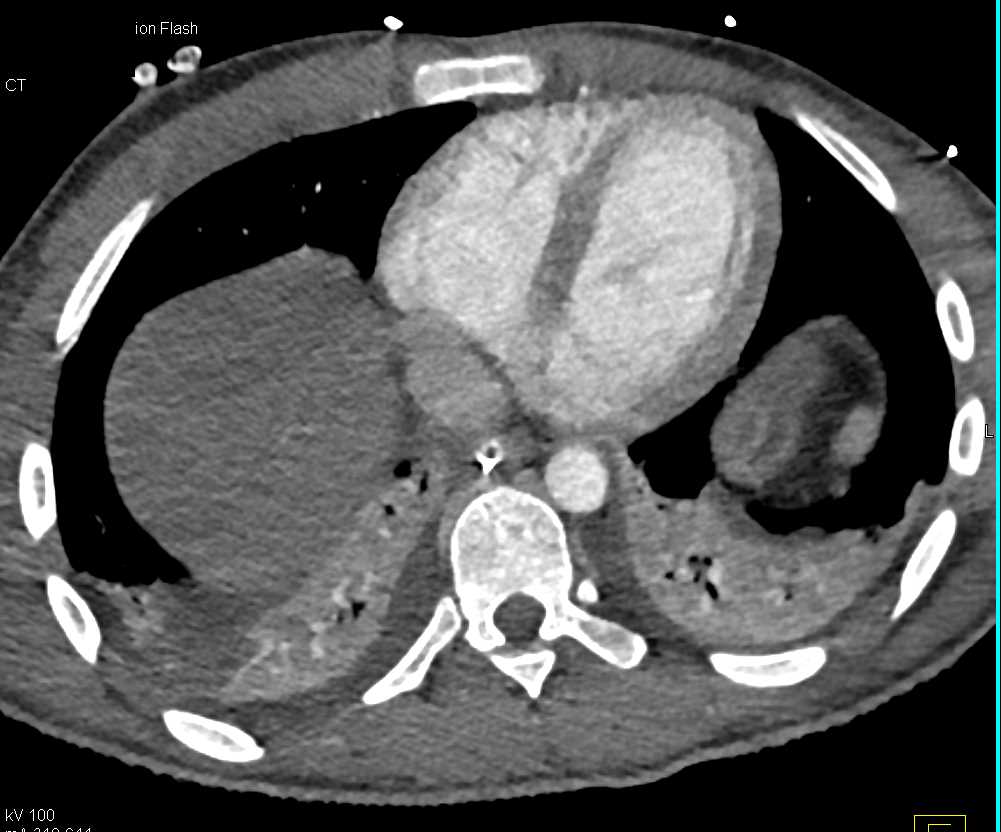 Consolidation and Collapse in the Lower Lung Fields - CTisus CT Scan