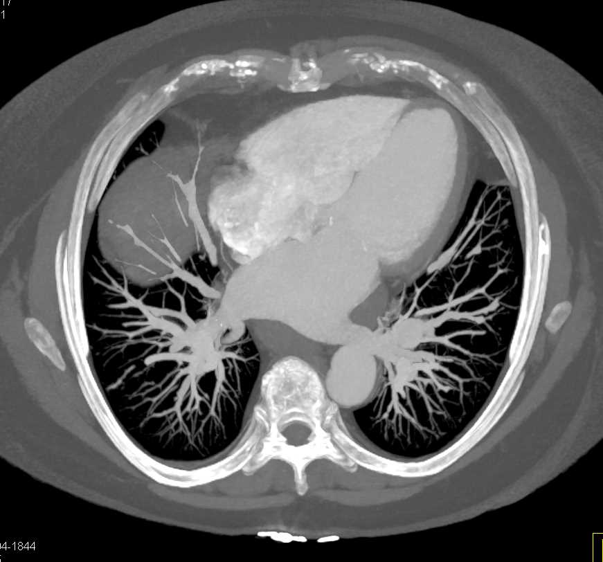 Multiple Pulmonary Arteriovenous Malformations (AVM) - CTisus CT Scan