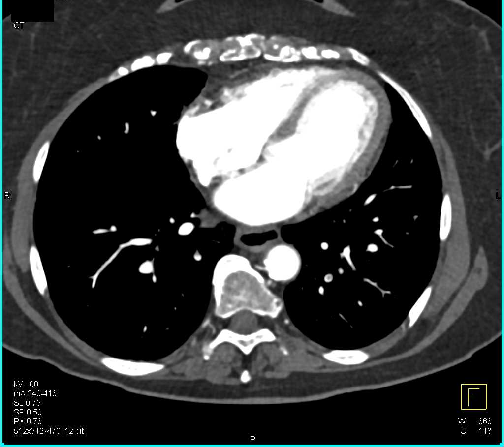 Pulmonary Embolism in a Patient with a Cystic Pancreatic Mass - CTisus CT Scan