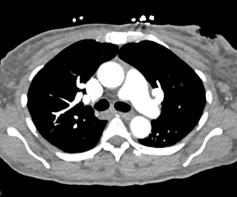 Ulcerating Left Breast Cancer with Axillary Nodes - CTisus CT Scan