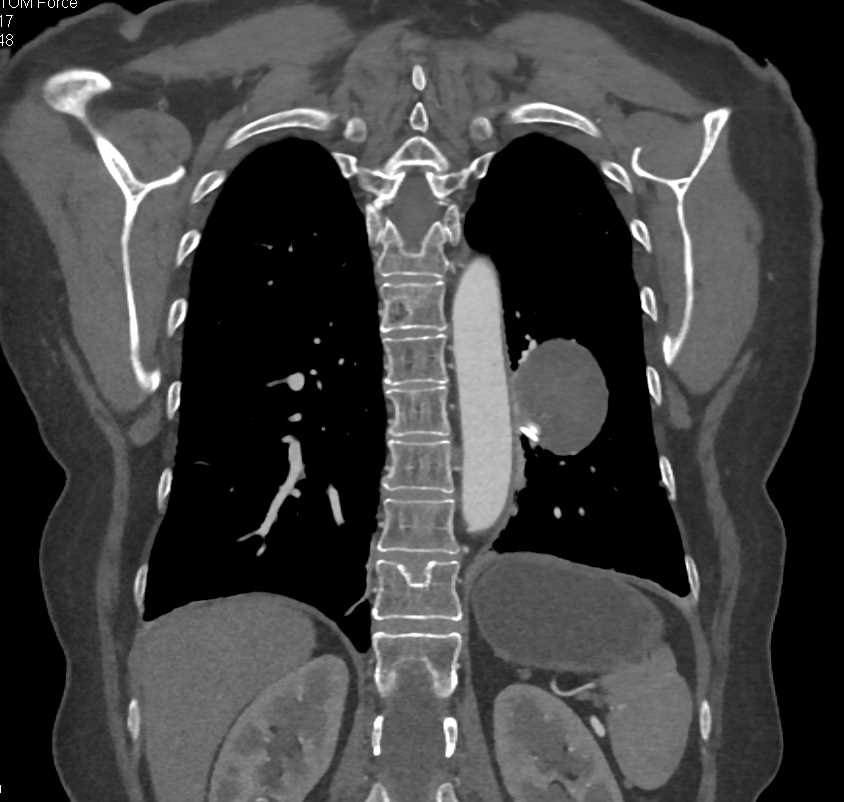 Embolized Pulmonary Artery Aneurysm - CTisus CT Scan