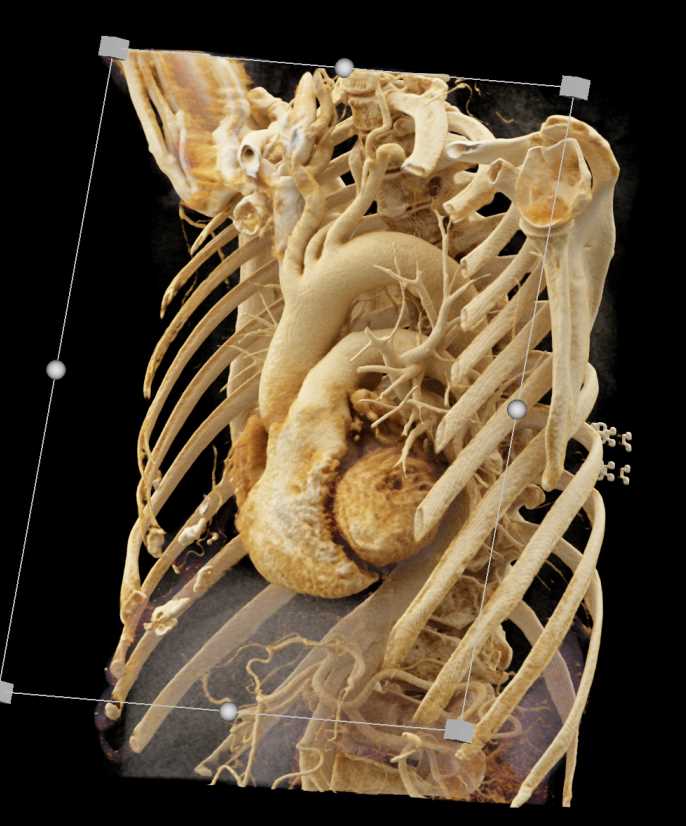 Embolized Pulmonary Artery Aneurysm with Cinematic Rendering - CTisus CT Scan