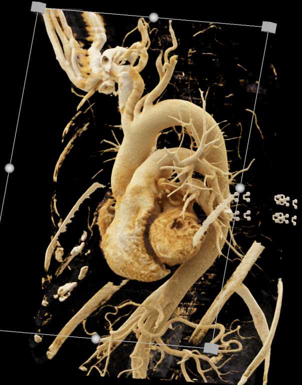 Embolized Pulmonary Artery Aneurysm with Cinematic Rendering - CTisus CT Scan