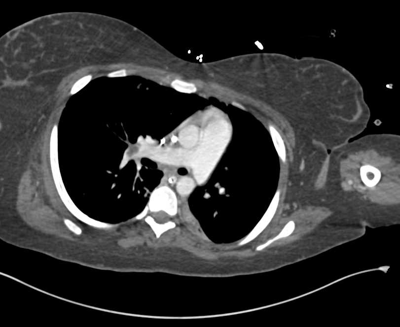 Pulmonary Embolism (PE) with Inferior Vena Cava (IVC) Clot and Pulmonary Infarction - CTisus CT Scan