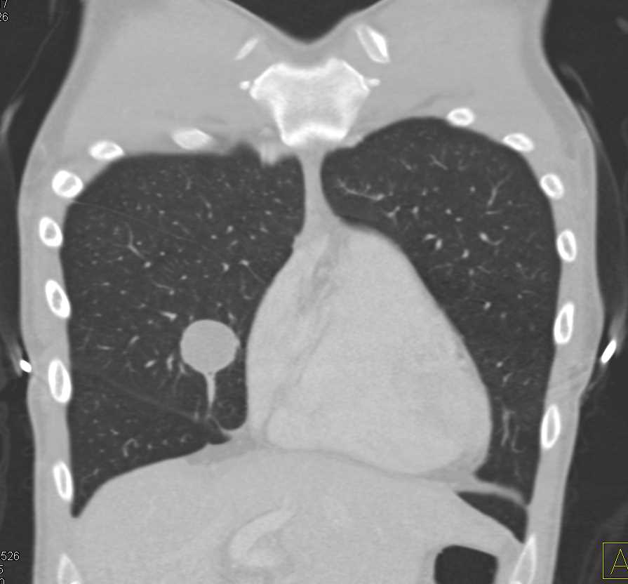 Pulmonary Hamartoma - CTisus CT Scan