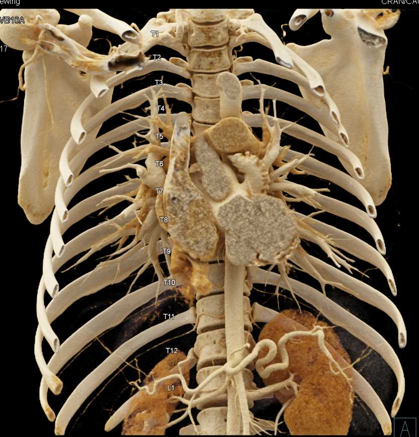 Cinematic Rendering with Automatic Rib Counting - CTisus CT Scan