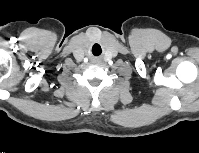 Parathyroid Adenoma - CTisus CT Scan