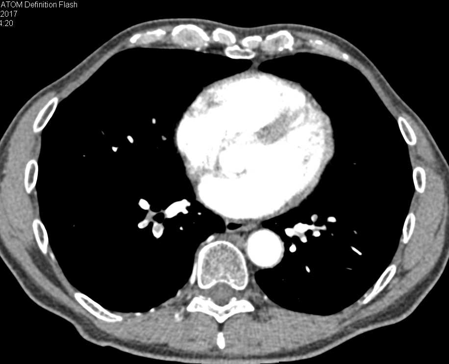 Pulmonary Embolism in Post Op Patient - CTisus CT Scan