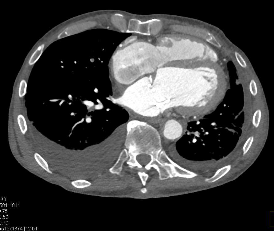 Pulmonary Embolism - CTisus CT Scan