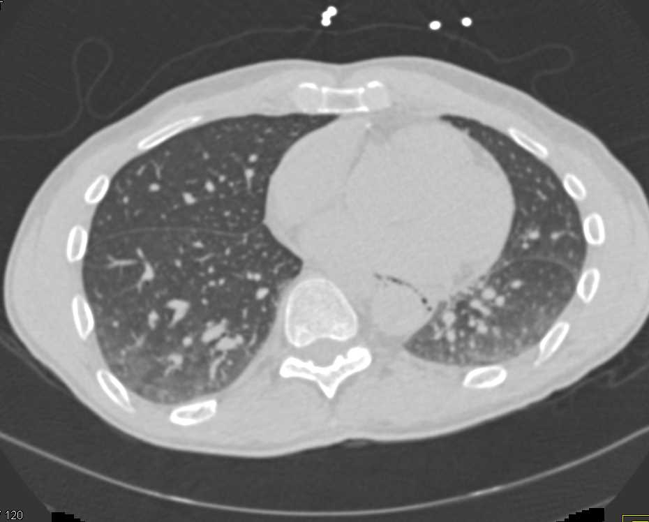 Severe Esophagitis with Pneumomediastinum - CTisus CT Scan