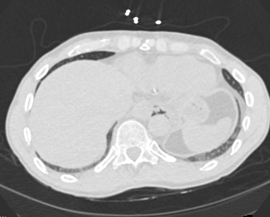 Severe Esophagitis with Pneumomediastinum - CTisus CT Scan