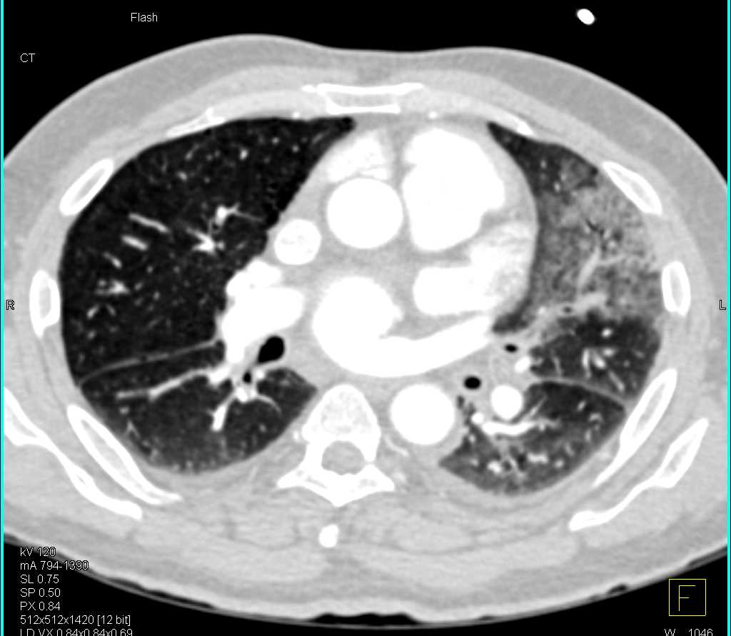 Multiple Pulmonary Emboli - CTisus CT Scan