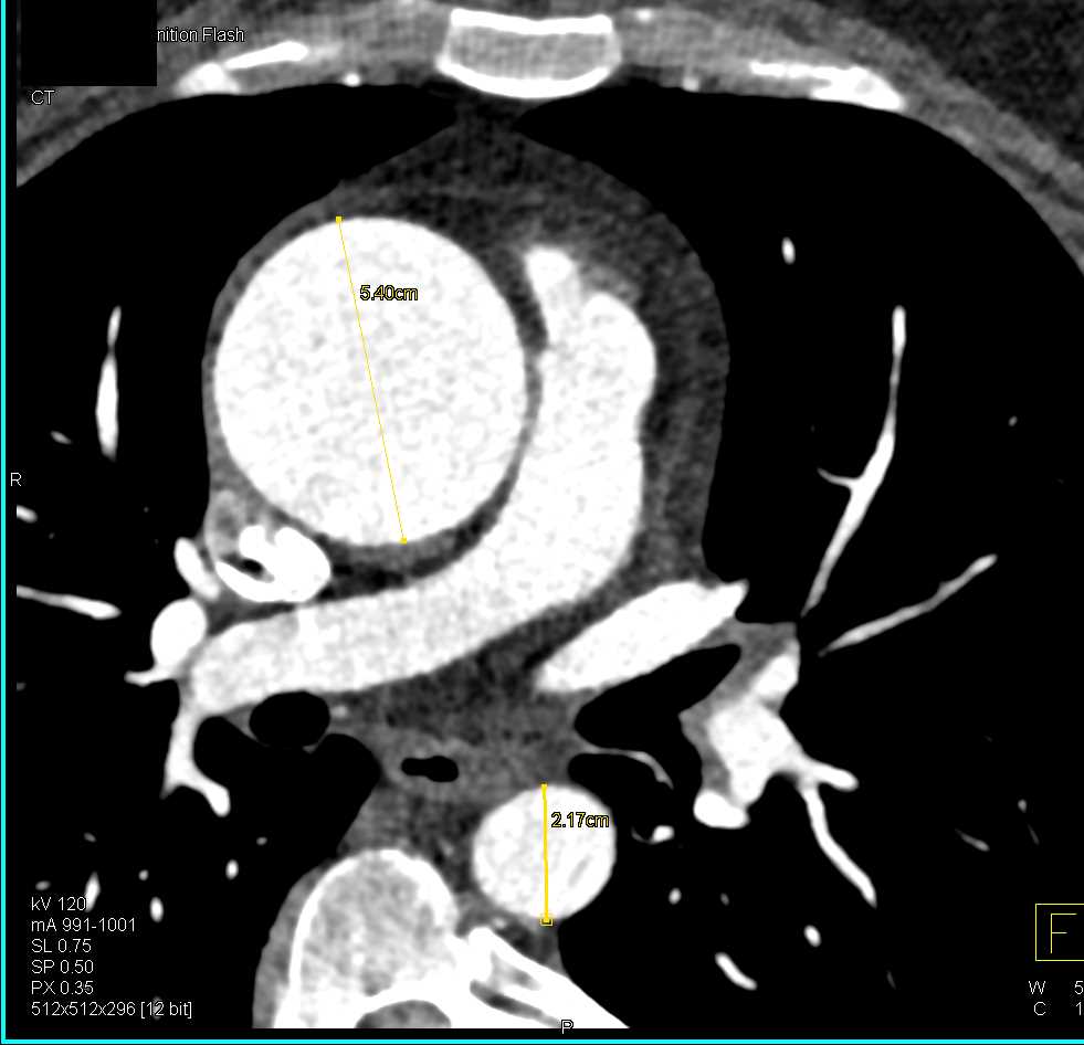 Bicuspid Aortic Valve and Dilated Ascending Aorta - CTisus CT Scan