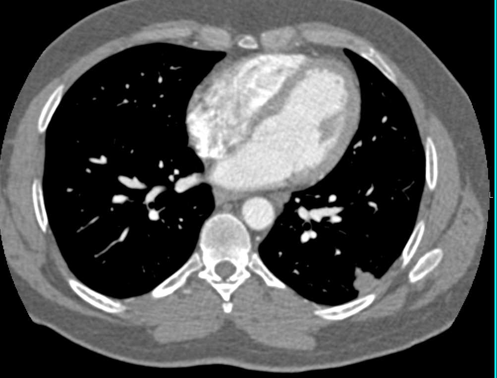 Pulmonary Arteriovenous Malformation (PAVM) Left Lower Lung - CTisus CT Scan