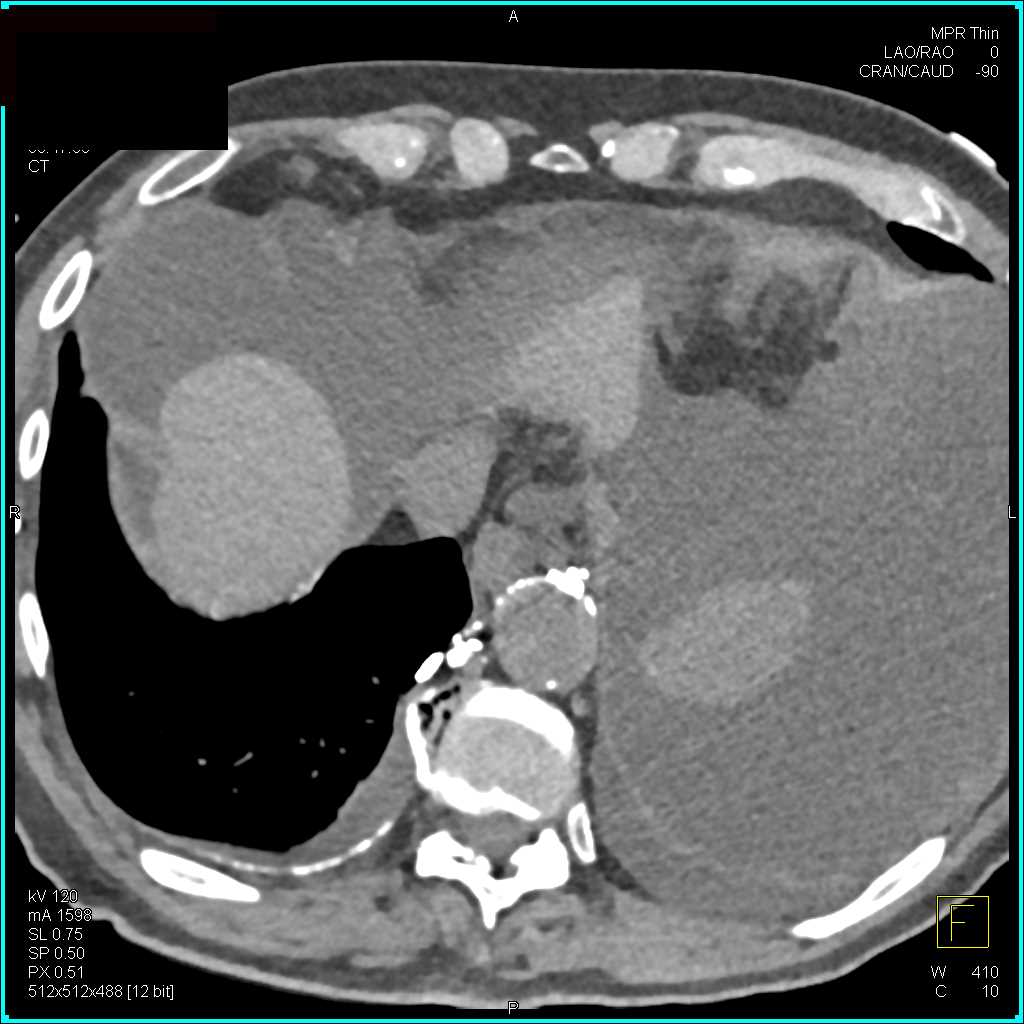 Broken Stent in the Right Pulmonary Artery - CTisus CT Scan