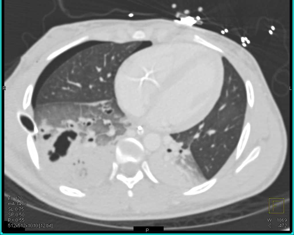 Pulmonary Contusion and Laceration and Liver Laceration s/p Trauma - CTisus CT Scan