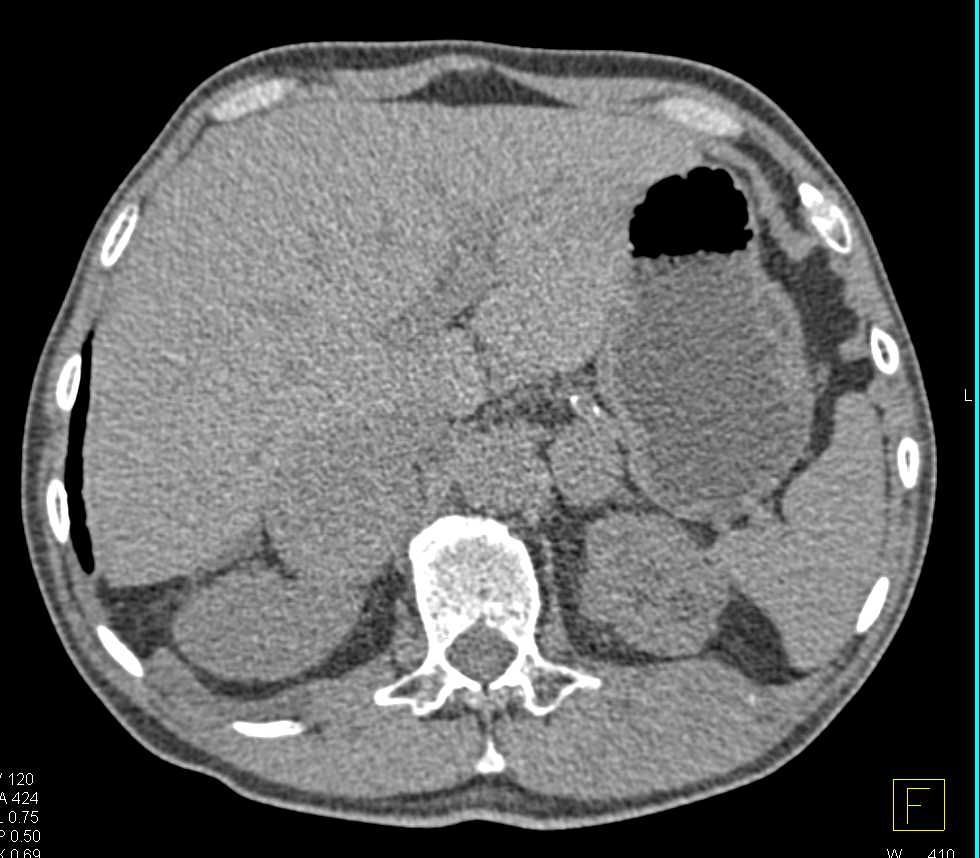 Metastatic Melanoma to the Adrenal and Lungs - CTisus CT Scan