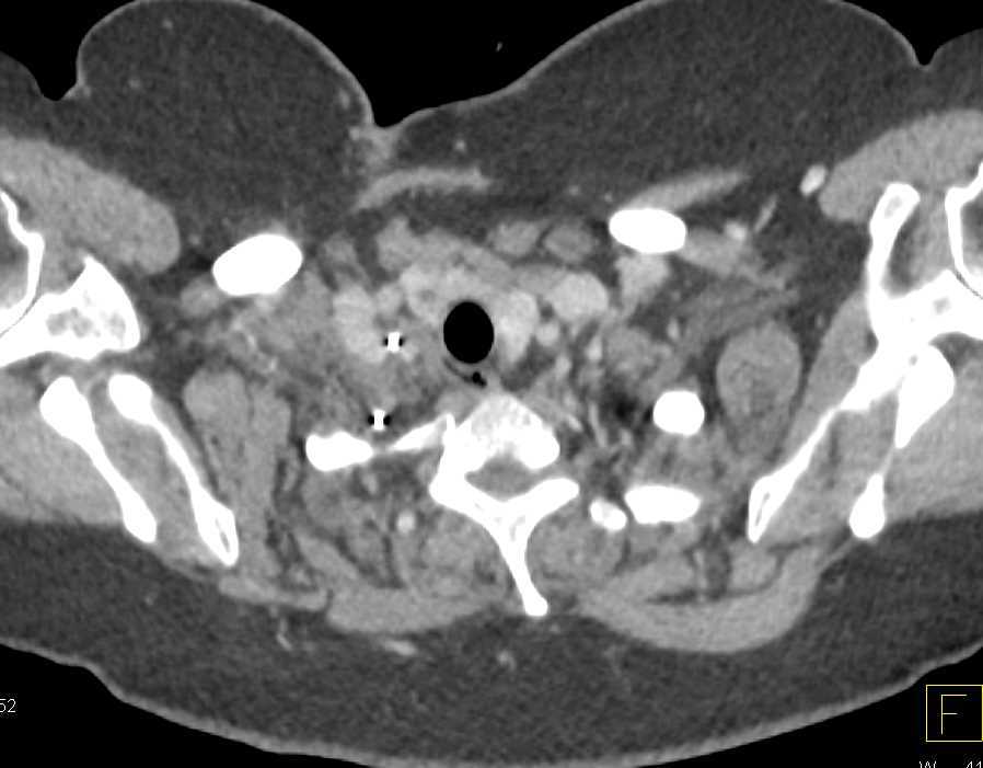 Inflammation Soft Tissue Above Right Lung Apex - CTisus CT Scan