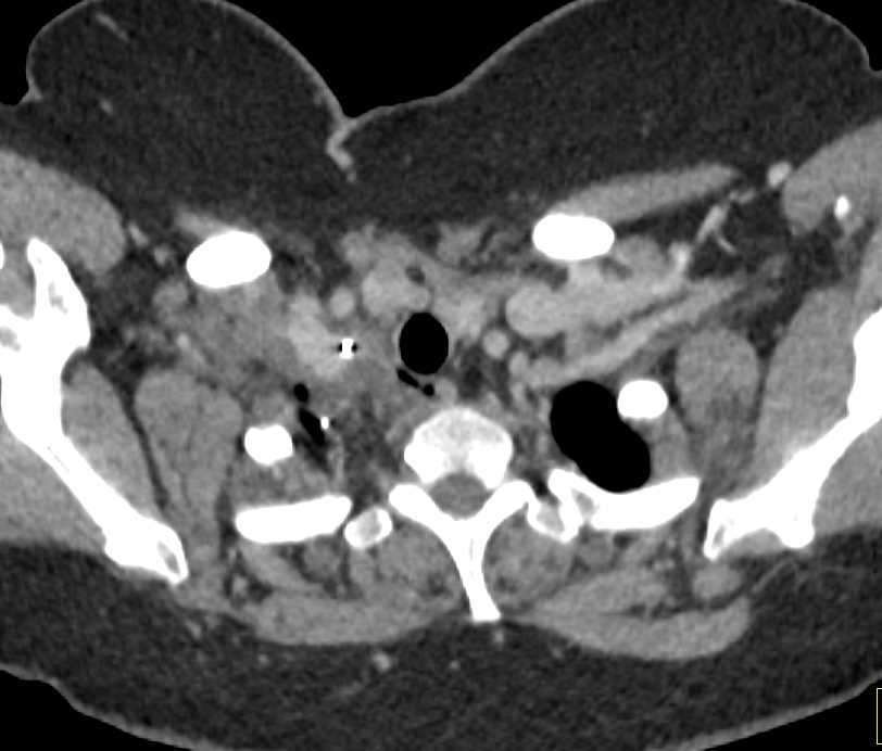 Inflammation Soft Tissue Above Right Lung Apex - CTisus CT Scan