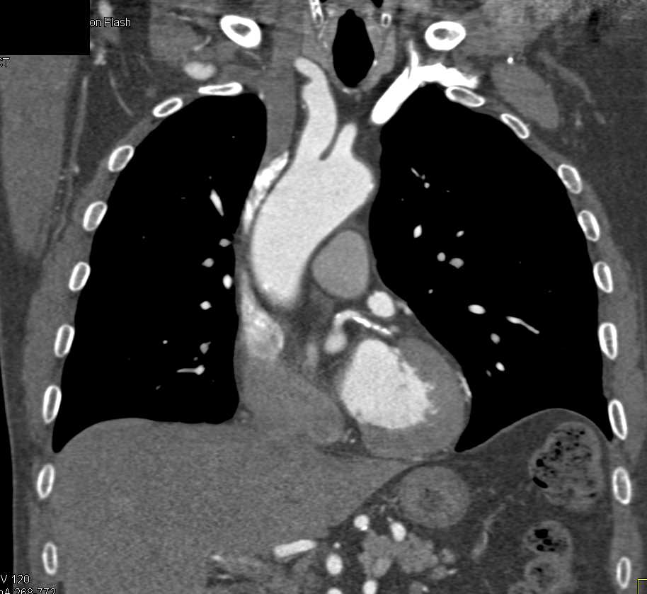 Aortic Valve Calcification and Coronary Artery Calcification - CTisus CT Scan