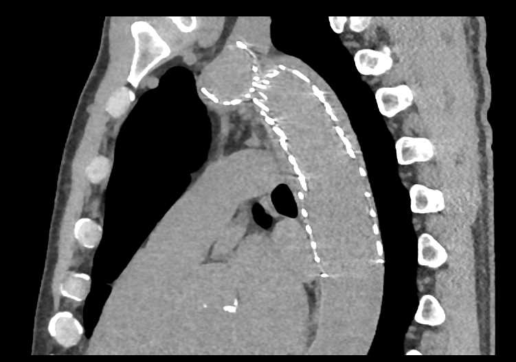 Endovascular Stent Aorta from Coarctation of the Aorta (COA) Repair - CTisus CT Scan
