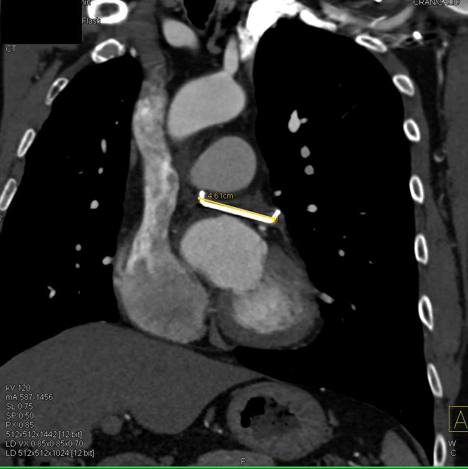 Hardware Positioning - CTisus CT Scan