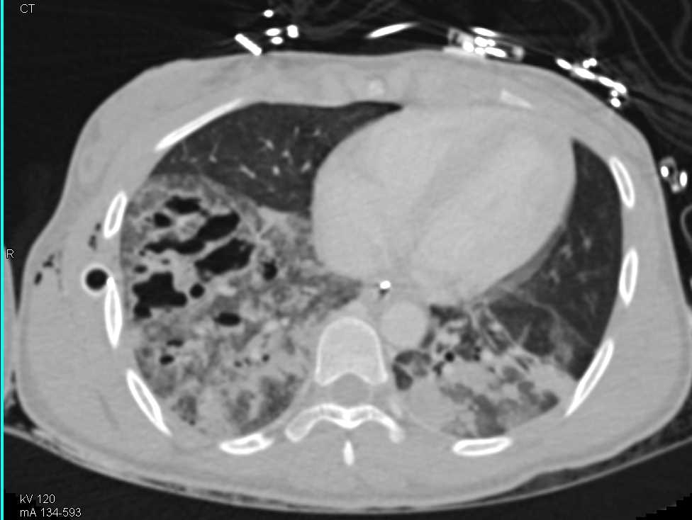 Infiltrate Right Lower Lung - CTisus CT Scan