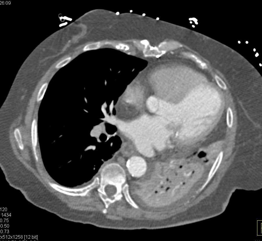 Collapsed Left Lower Lung due to Tumor - CTisus CT Scan