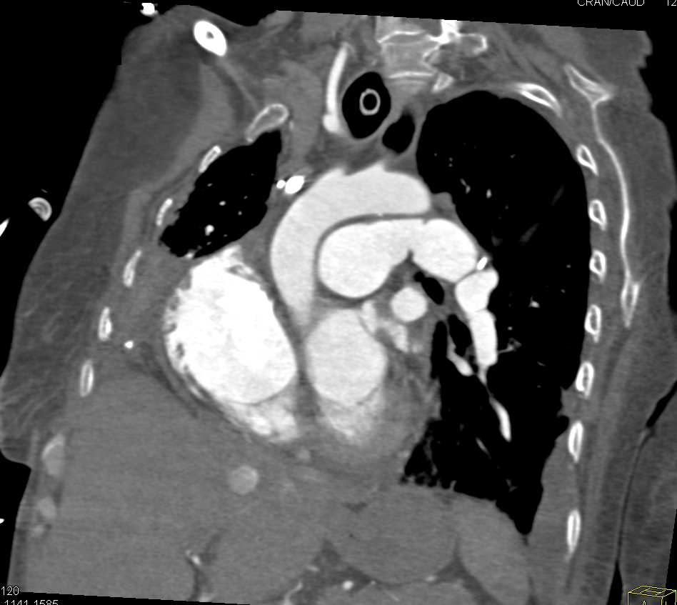 Looking at the AP Window - CTisus CT Scan