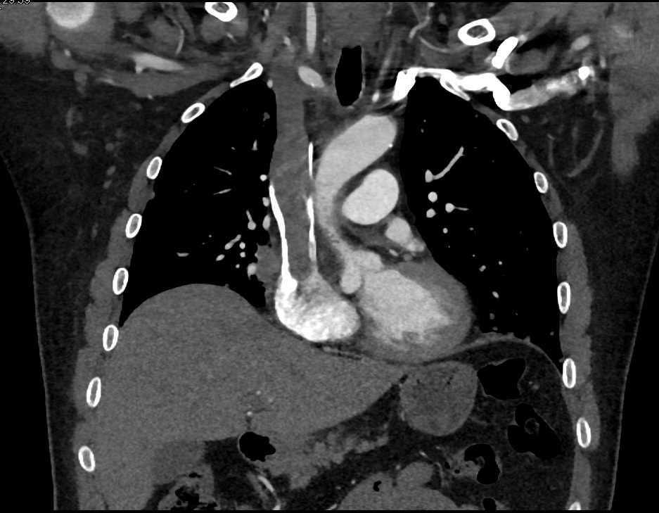 Superior Vena Cava (SVC) Thrombus which Simulates Flow Related Changes - CTisus CT Scan