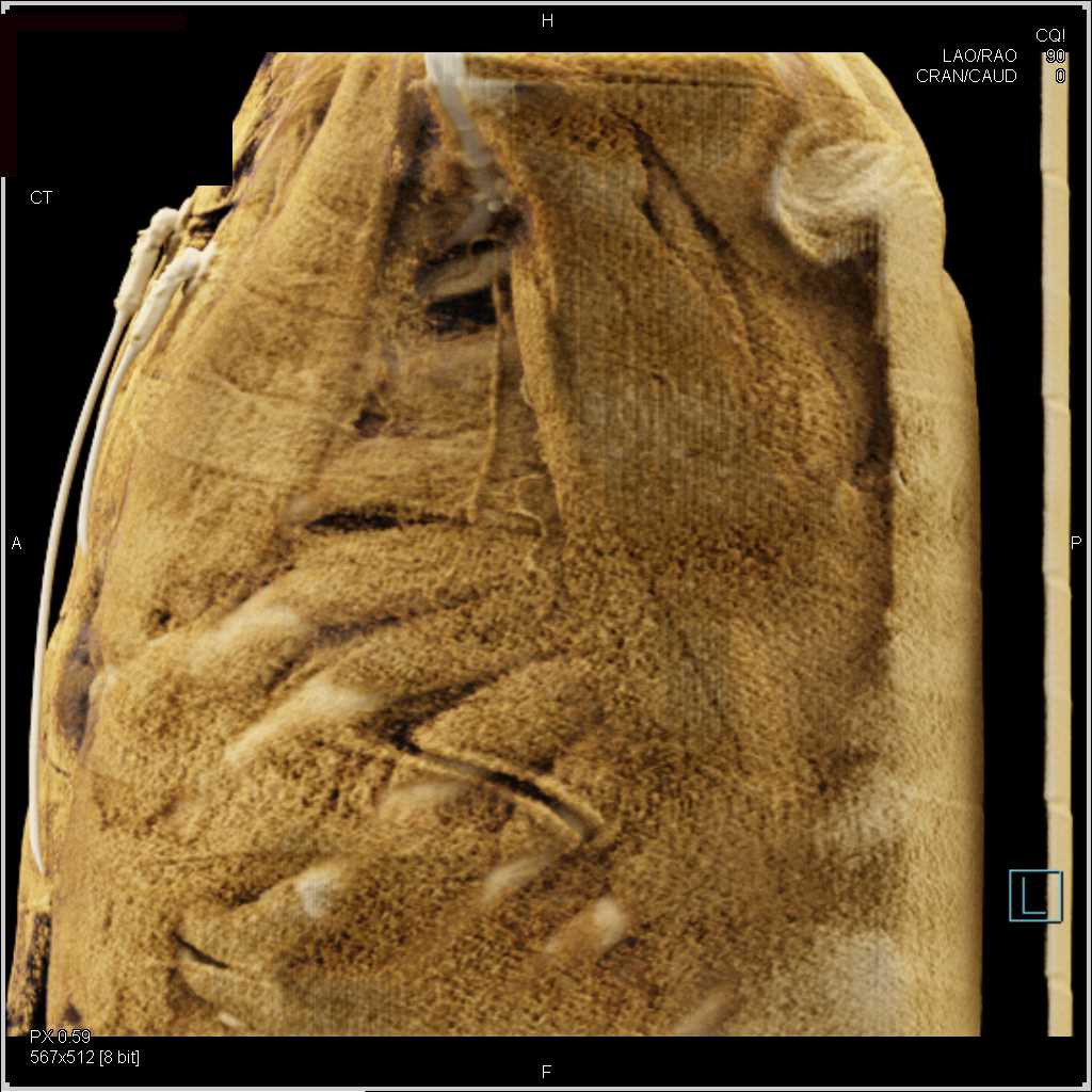 Thymoma - CTisus CT Scan